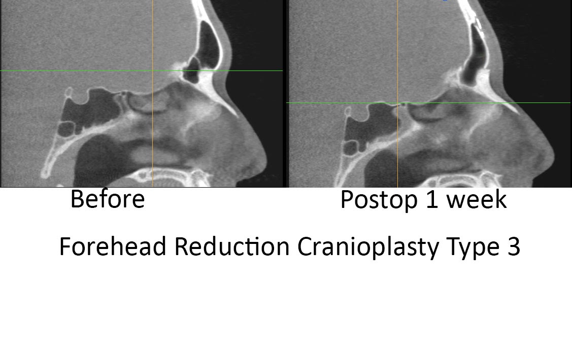 Facial Feminization Surgery - Forehead Reduction Cranioplasty Type 3