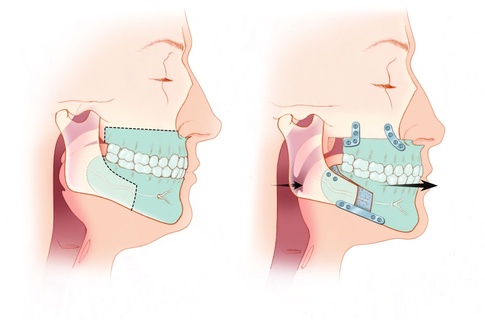 Double jaw surgery maxillo-mandibular advancement