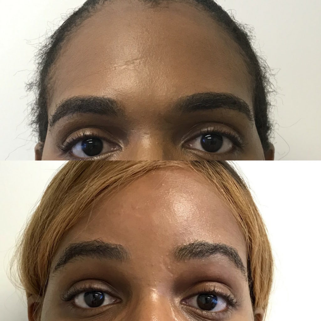 Browlift Facial Feminization Surgery