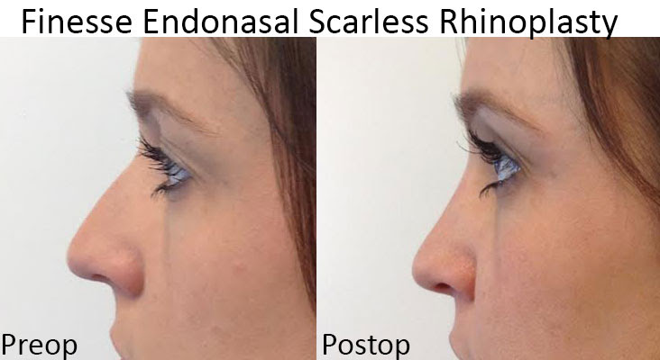 Rhinoplasty