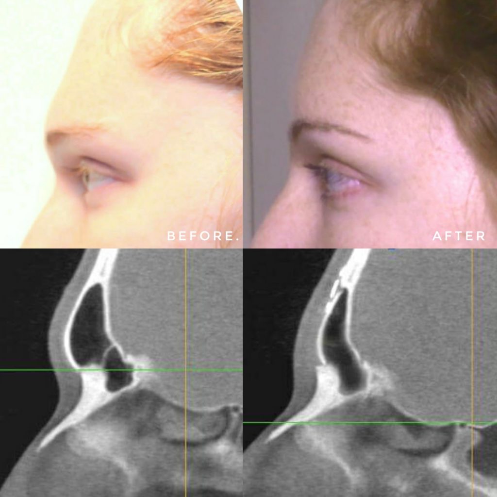 Forehead Cranioplasty Type 3 Facial Feminization Surgery