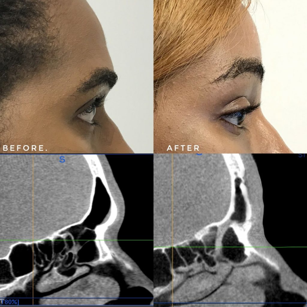 Type 3 Forehead Feminization Cranioplasty
