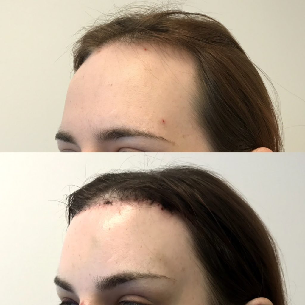 Hairline Feminization Hairline Lowering Forehead Reduction