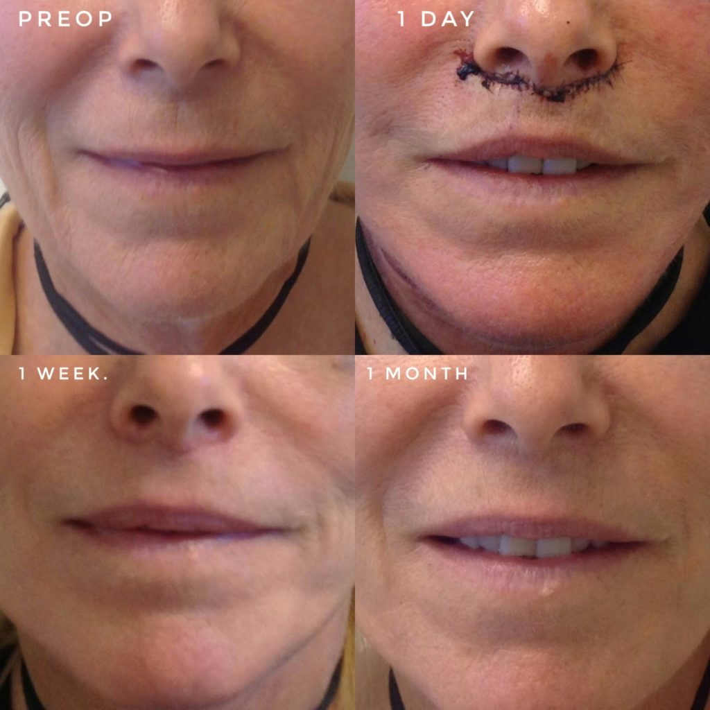 Lip Lift Facial Feminization Surgery