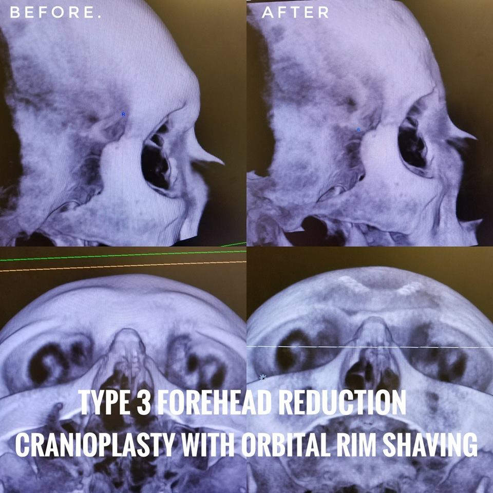 Type 3 Forehead Cranioplasty with Orbital Rim Reduction
