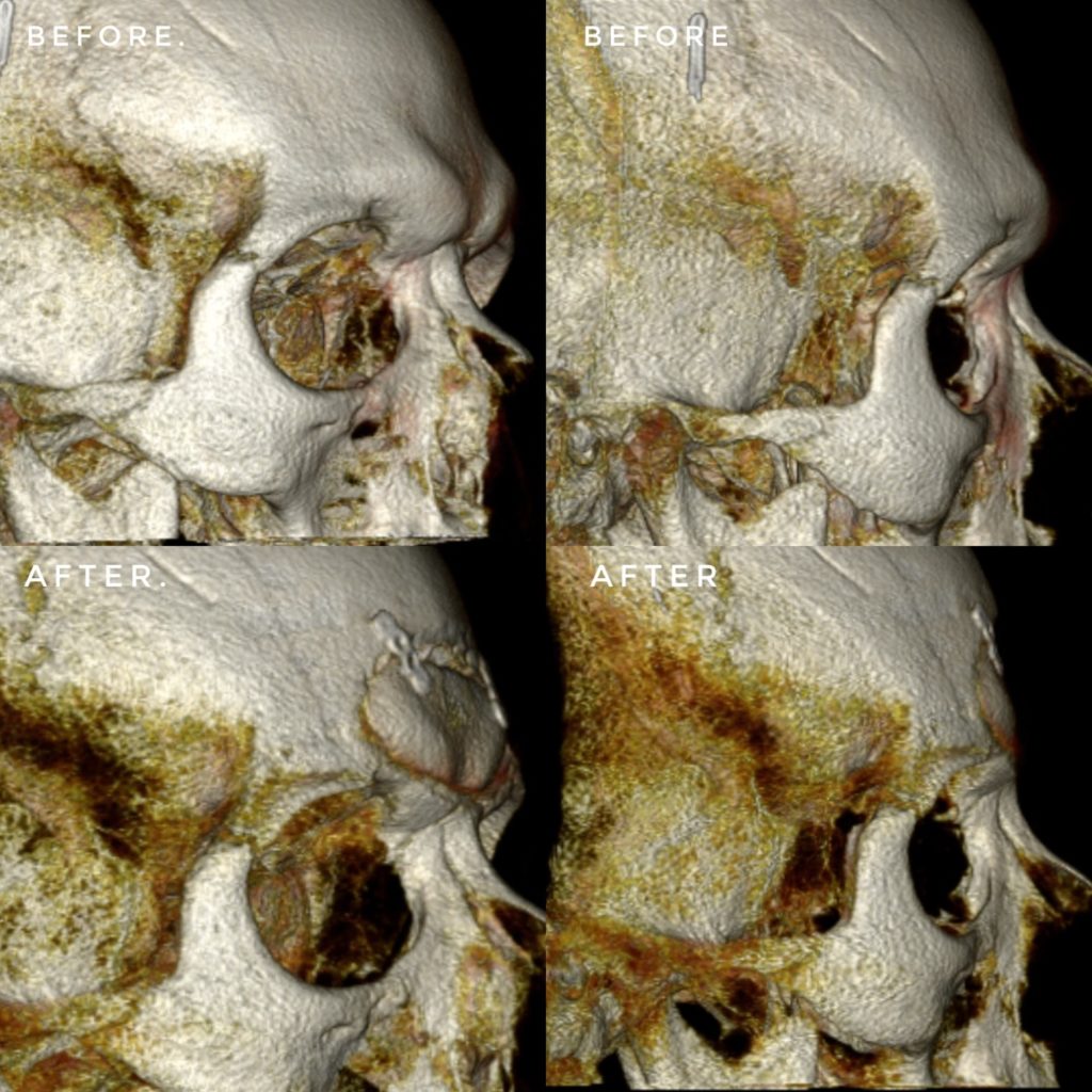 Forehead Feminization Cranioplasty Type 3 - Actual Patient