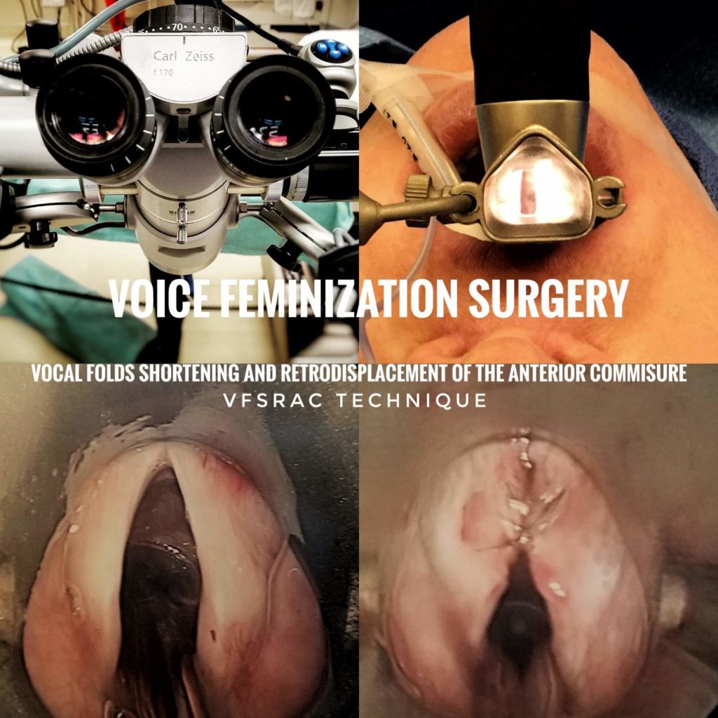 Voice Feminization Surgery Technique