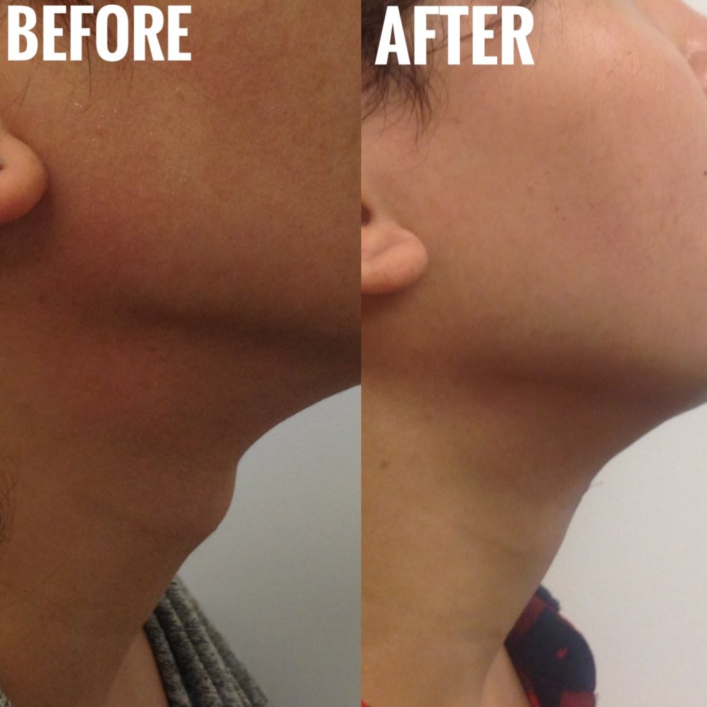 Tracheal Shave Adam's Apple Reduction