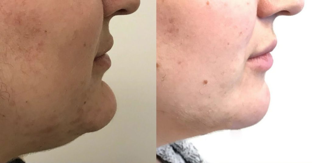 Chin Reduction