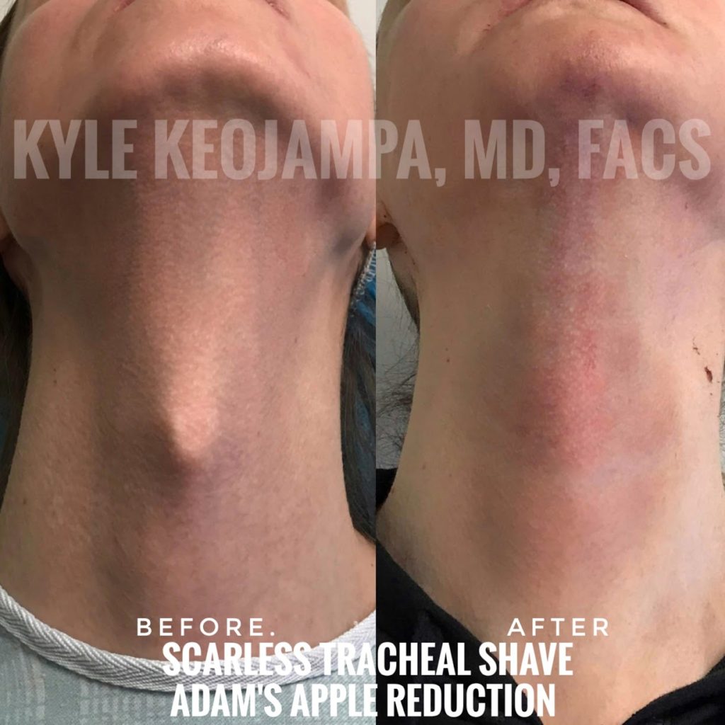 Scarless Tracheal Shave Keojampa